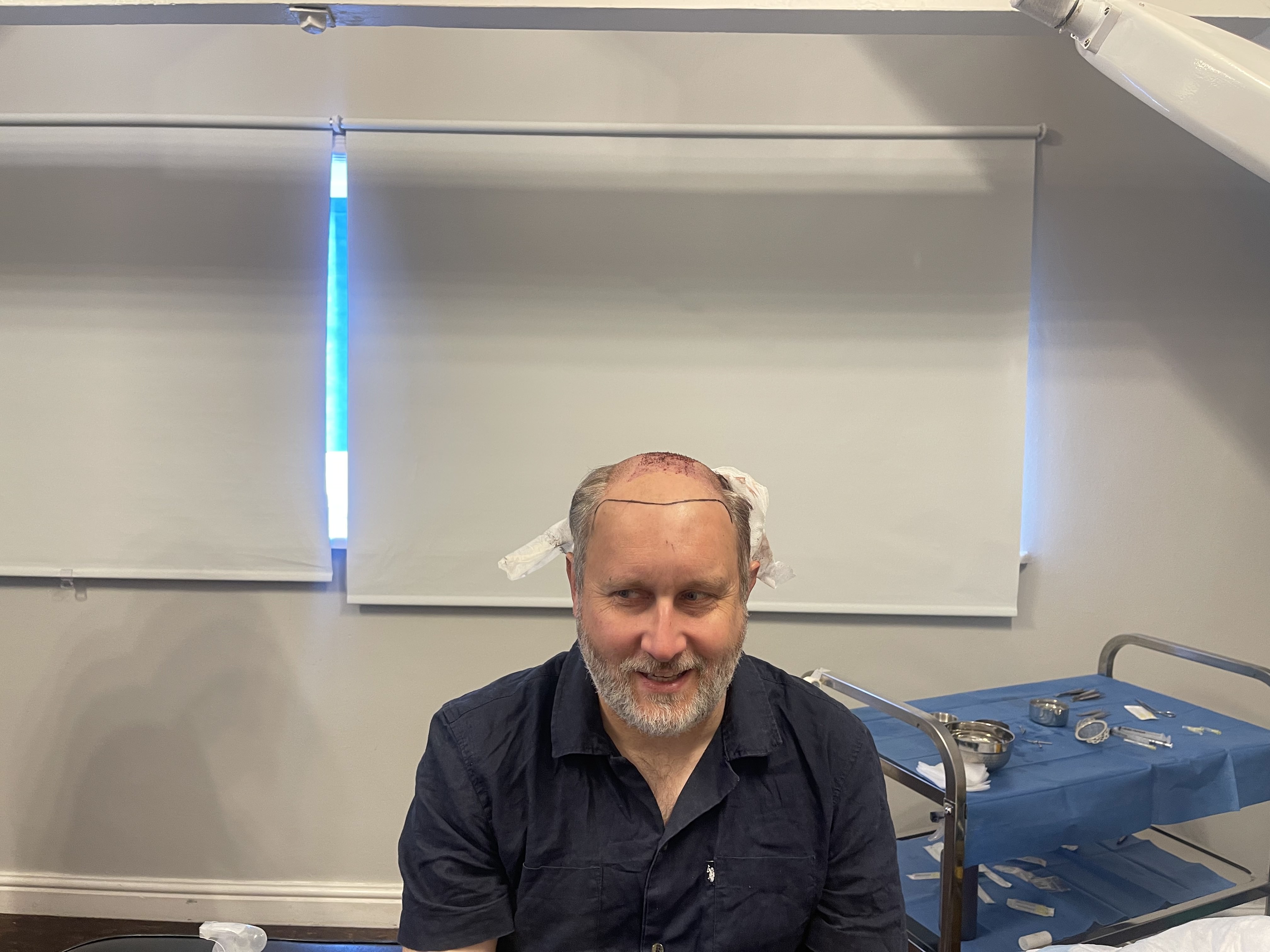 Norwood 7 hair transplant — Colin result photo 8